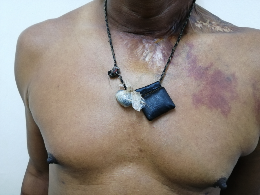 Advanced mycetoma with traditional native treatment.